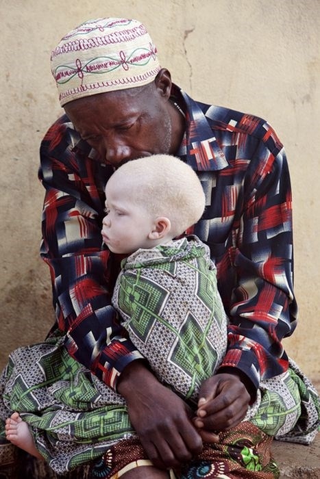 Пугающая судьба альбиносов Танзании