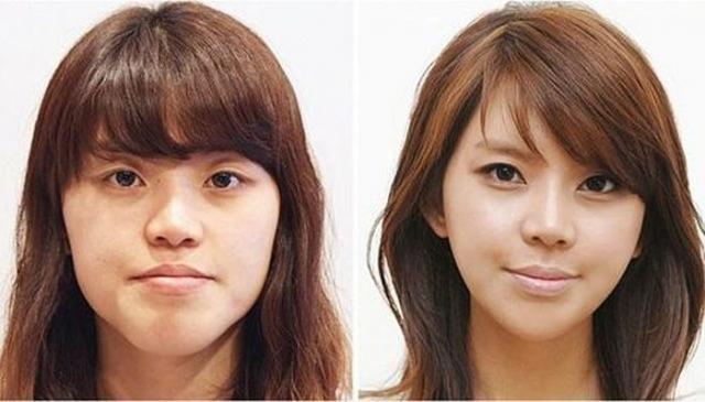 До и после пластической операции в одной из клиник Южной Кореи